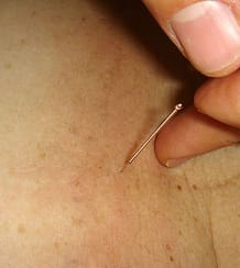 acupuncture
