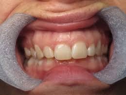 teeth whitening