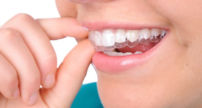 invisalign for teeth alignment
