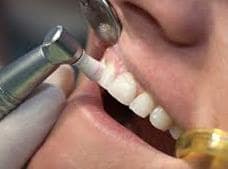 dental cleaning