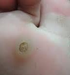 warts