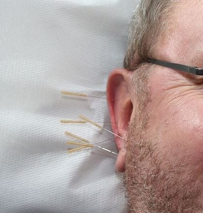 acupuncture